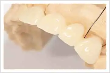 インプラントの治療中は歯がないままになりますか