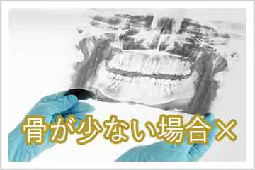 骨があまりないのですが、抜歯即時インプラントは可能ですか？