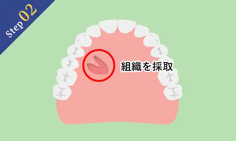 上顎の口蓋部分から歯茎の組織を採取