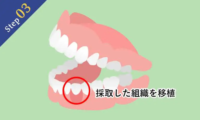 歯茎が不足している部分の上皮の内部に、採取した組織を移植