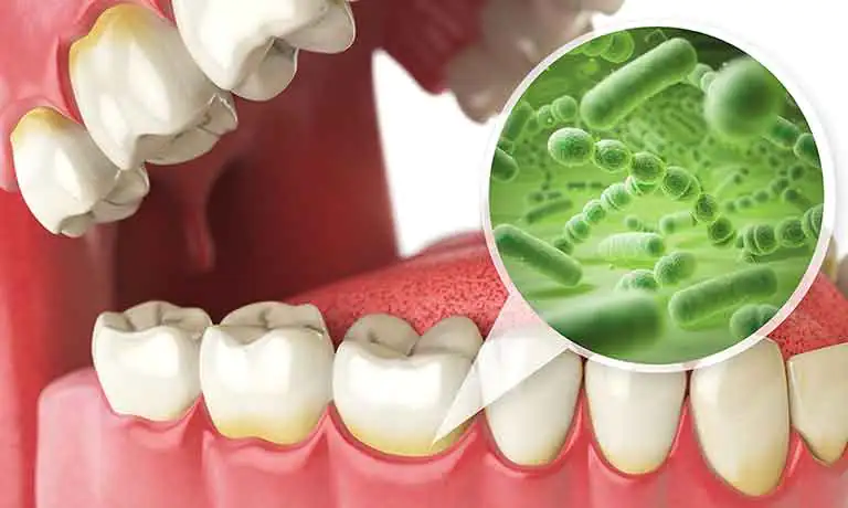 歯周再生療法・歯周外科