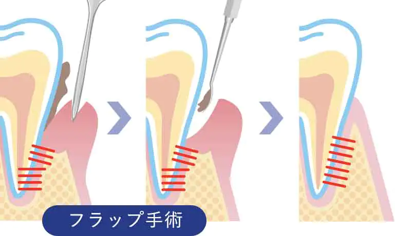 フラップ手術