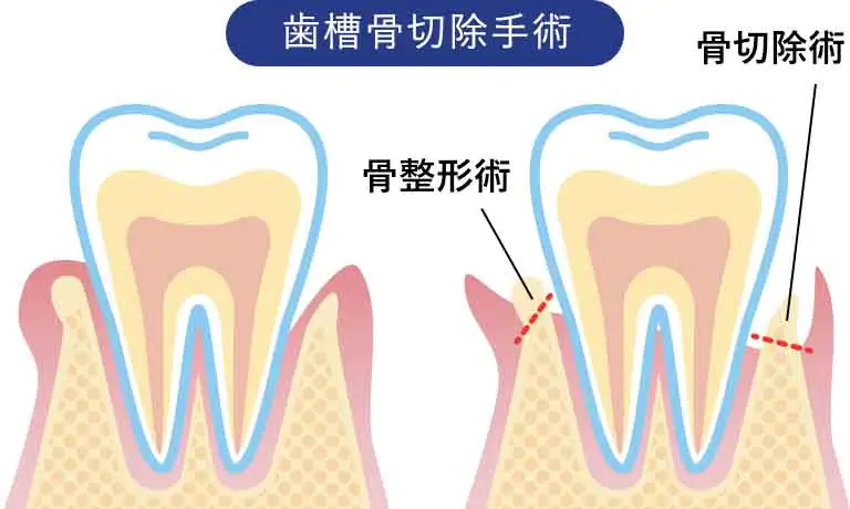 歯槽骨切除手術