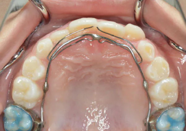 噛み合わせが逆になっている前歯に、裏側から細い針金をかけ、噛み合わせを改善していきます。