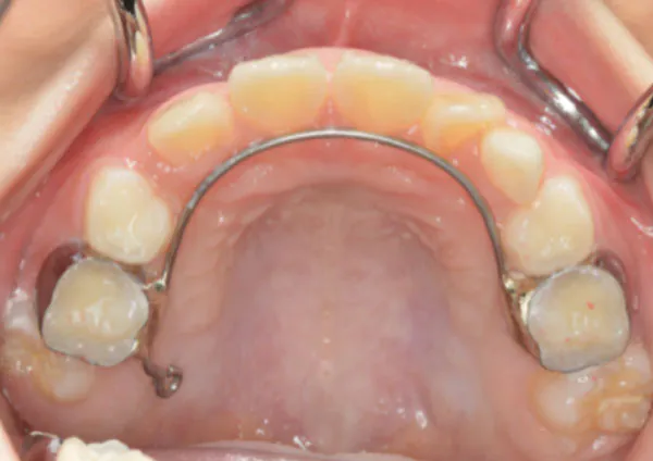 乳臼歯を固定源として、ずれた位置から生えてきている永久歯を、ゴムを使って正しい位置へと引っ張ります。