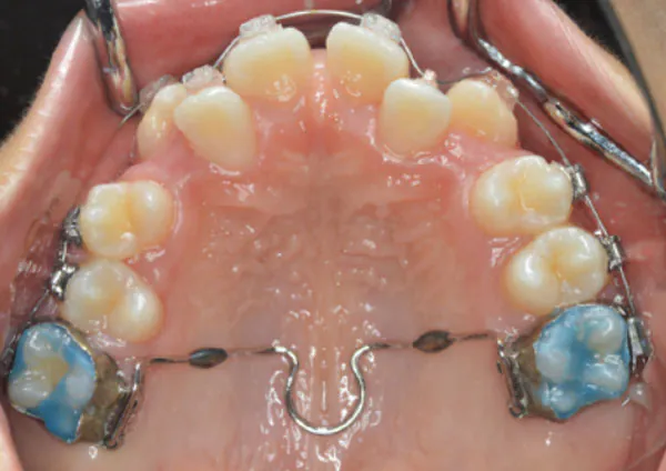 歯を並べていく際に、奥歯が前にずれて必要なスペースがなくなることを避けるため、固定源として使用します。