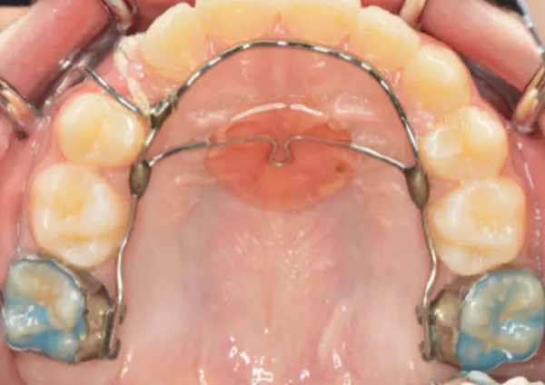 顎の骨の中に埋まっている歯を引っ張り誘導します。６歳児臼歯のみでは固定源として不十分であるため、上顎にもレジンパッドを使用し固定力を強化しています。