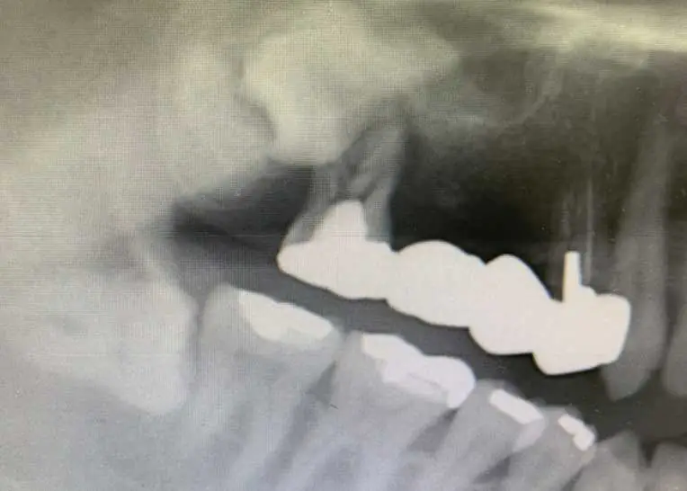 上顎の埋伏智歯とその遠心(後ろ側)の歯牙腫