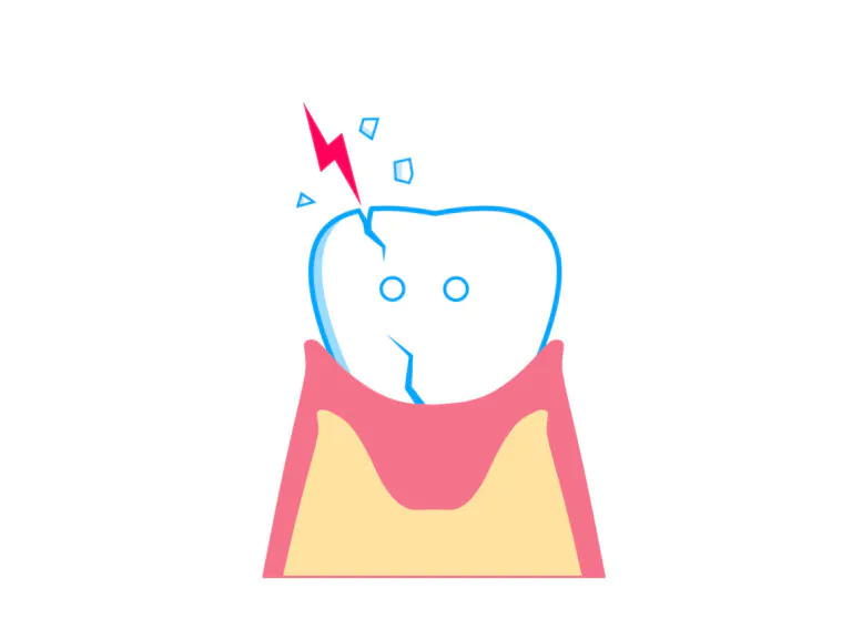 歯に縦線のひび割れ？ひびが入る原因とは