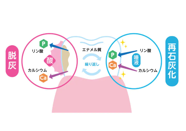 毎日の食習慣で歯が溶ける病気「酸蝕症」とは？