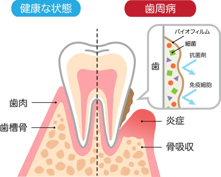 歯を失う原因の第一位「歯周病」とは？