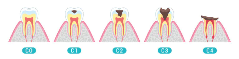 虫歯の見た目や症状と治し方